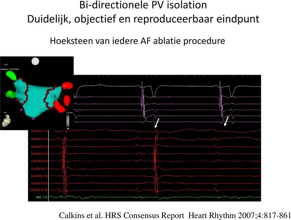 AF ablatie procedure DELAY PV ISOLATION Calkins et