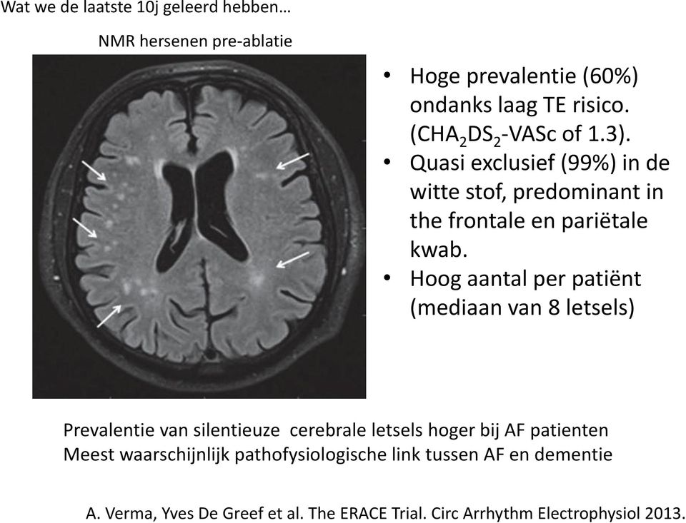 (CHA 2 DS 2 -VASc of 1.3). Quasi exclusief (99%) in de witte stof, predominant in the frontale en pariëtale kwab.