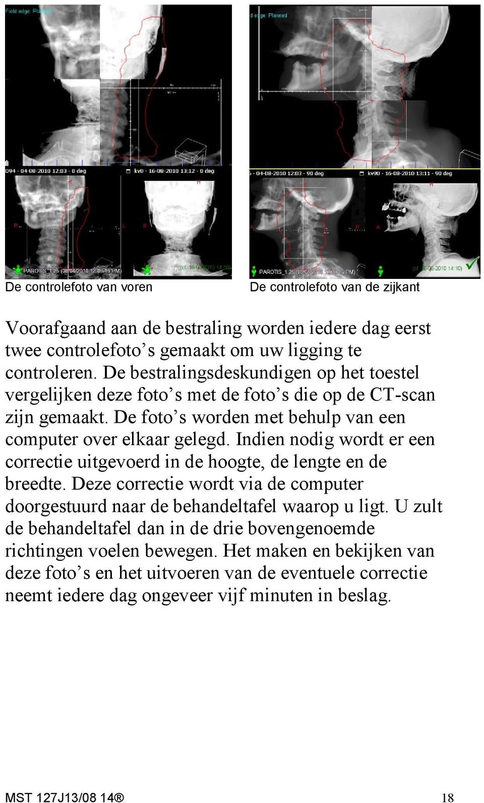 Indien nodig wordt er een correctie uitgevoerd in de hoogte, de lengte en de breedte. Deze correctie wordt via de computer doorgestuurd naar de behandeltafel waarop u ligt.