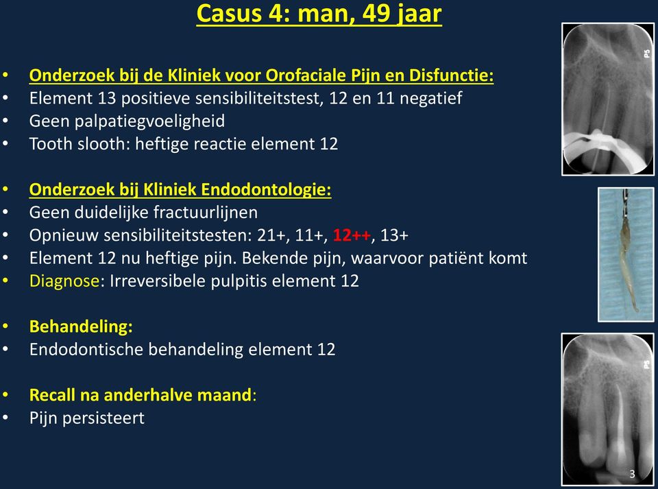 fractuurlijnen Opnieuw sensibiliteitstesten: 21+, 11+, 12++, 13+ Element 12 nu heftige pijn.