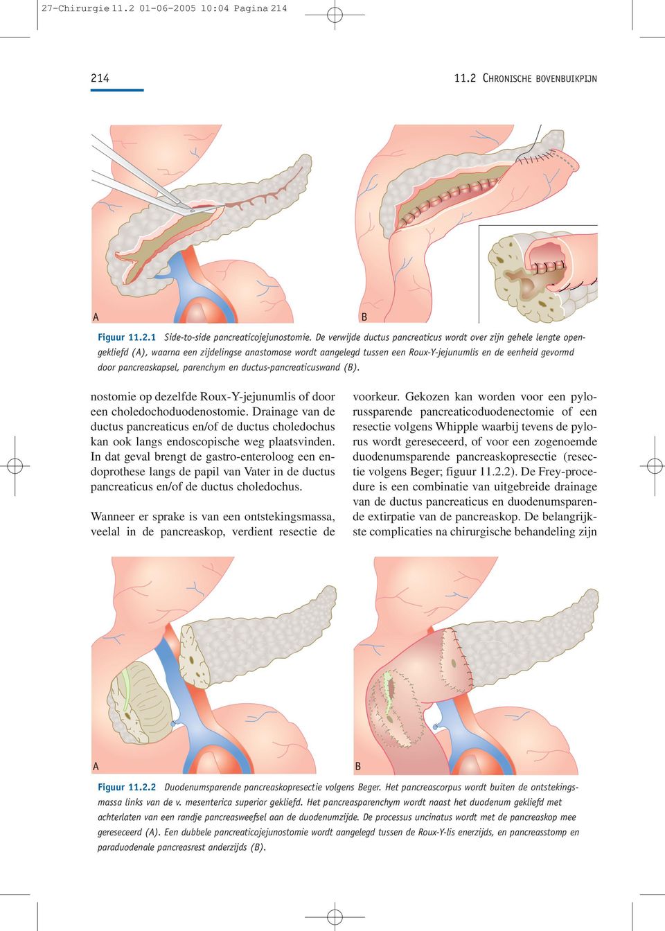 pancreaskapsel, parenchym en ductus-pancreaticuswand (B). nostomie op dezelfde Roux-Y-jejunumlis of door een choledochoduodenostomie.