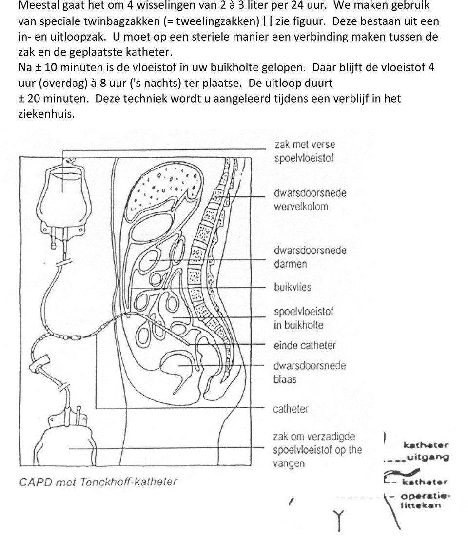 U moet op een steriele manier een verbinding maken tussen de zak en de geplaatste katheter.