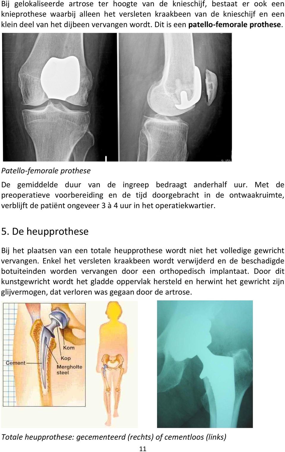 Met de preoperatieve voorbereiding en de tijd doorgebracht in de ontwaakruimte, verblijft de patiënt ongeveer 3 à 4 uur in het operatiekwartier. 5.