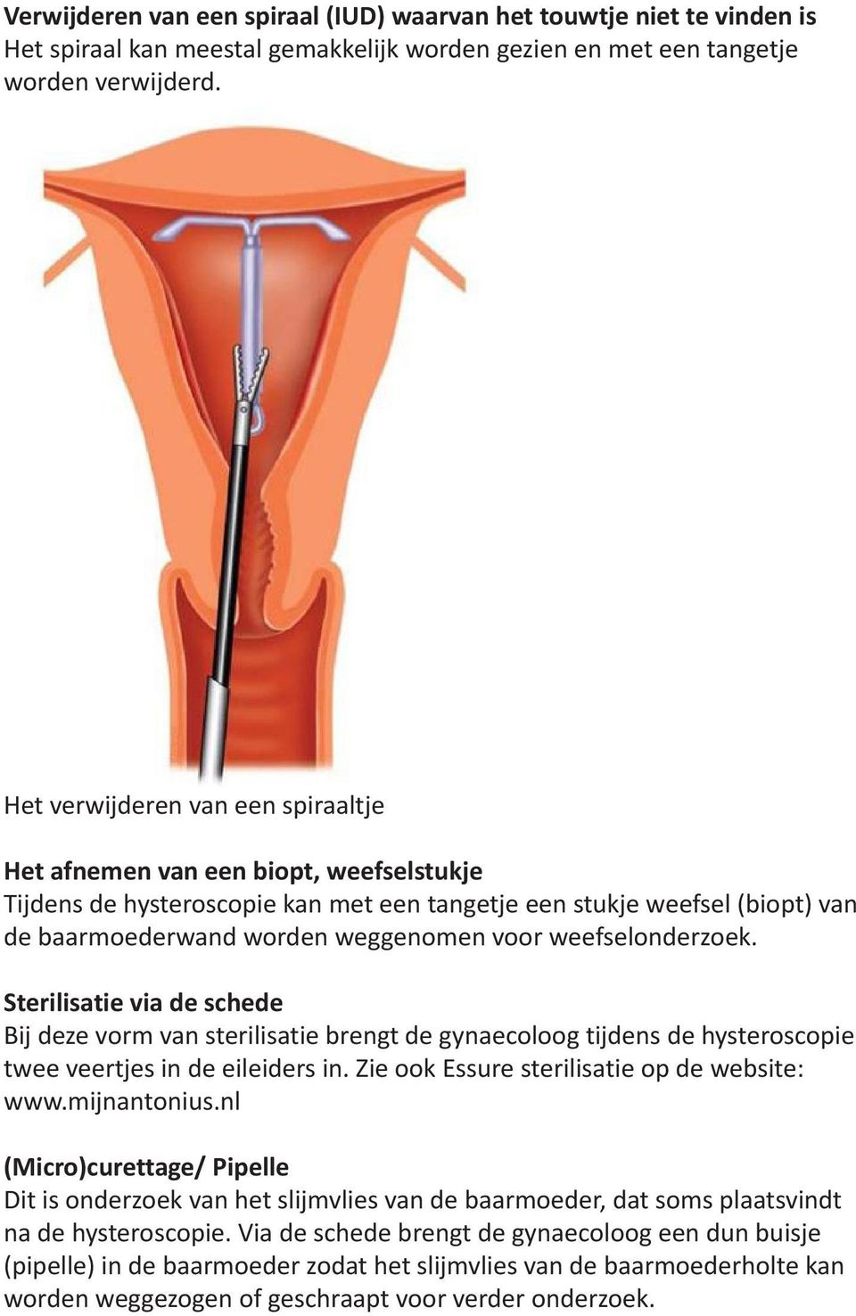 weefselonderzoek. Sterilisatie via de schede Bij deze vorm van sterilisatie brengt de gynaecoloog tijdens de hysteroscopie twee veertjes in de eileiders in.