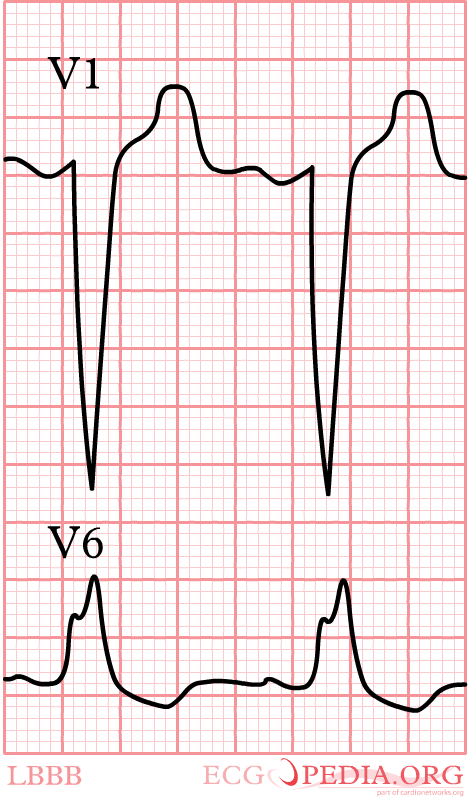 LBTB QRS > 0.