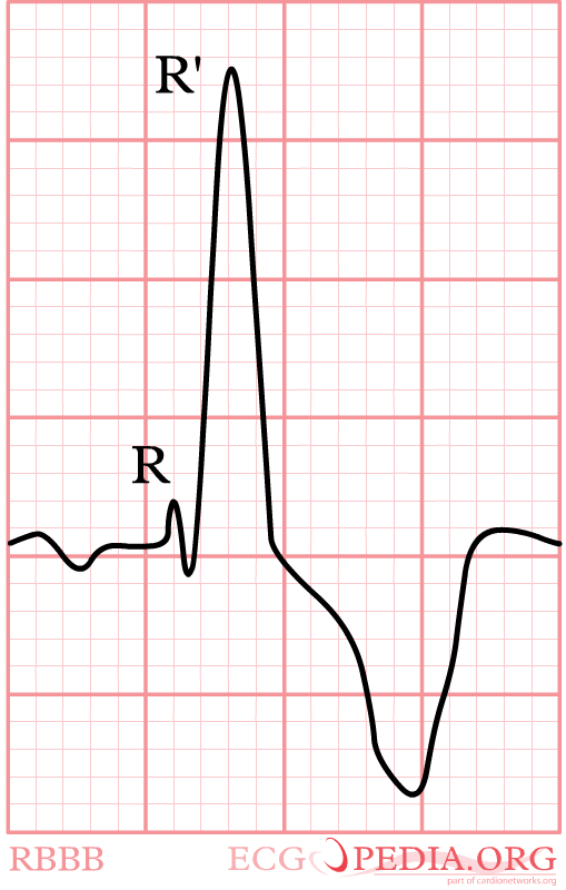 RBTB QRS > 0.