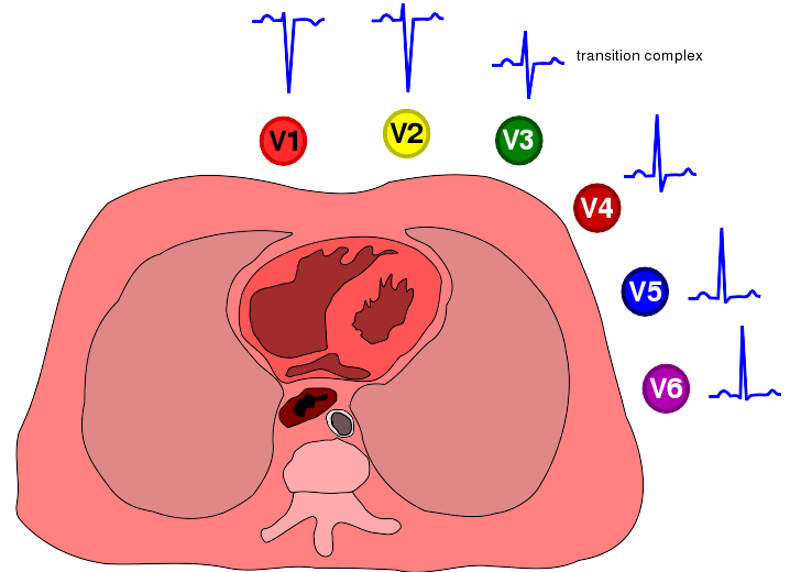 7+2 STAPPENPLAN Stap 6: QRS morfologie R-top progressie?