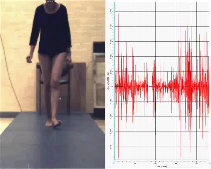 Casus 4: semg bij Parkinson met dystonie Video + synchroon