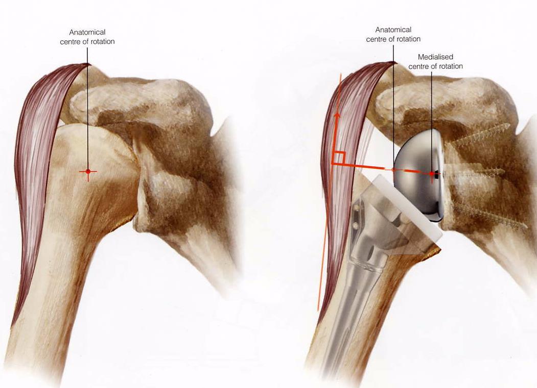 Cuffarthropathie