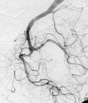 11 1C: 3D-angiogram van dezelfde patiënt, waarbij een projectie wordt gezocht waarbij de relatie van de nek van het aneurysma met de