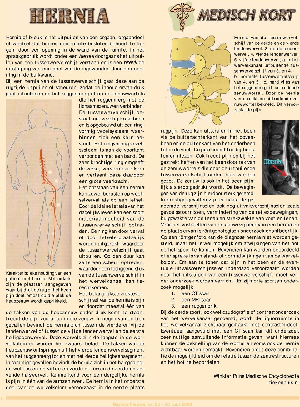 Bij een hernia van de tussenwervelschijf gaat deze aan de rugzijde uitpuilen of scheuren, zodat de inhoud ervan druk gaat uitoefenen op het ruggenmerg of op de zenuwwortels die het ruggenmerg met de