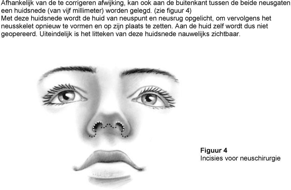 (zie figuur 4) Met deze huidsnede wordt de huid van neuspunt en neusrug opgelicht, om vervolgens het neusskelet