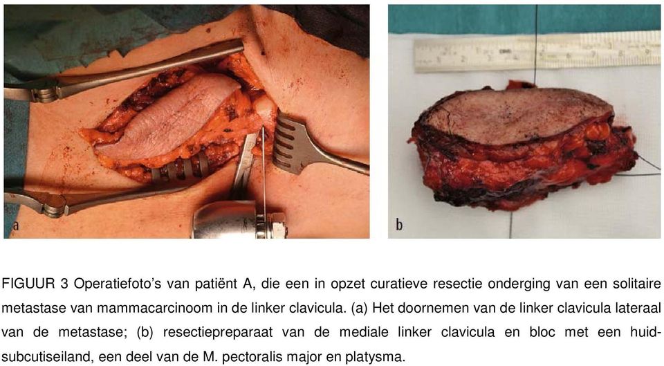 (a) Het doornemen van de linker clavicula lateraal van de metastase; (b) resectiepreparaat