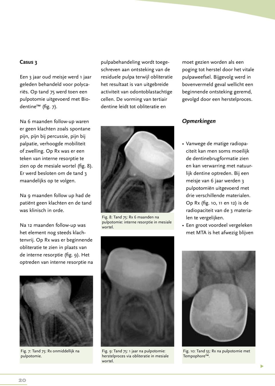 De vorming van tertiair dentine leidt tot obliteratie en moet gezien worden als een poging tot herstel door het vitale pulpaweefsel.