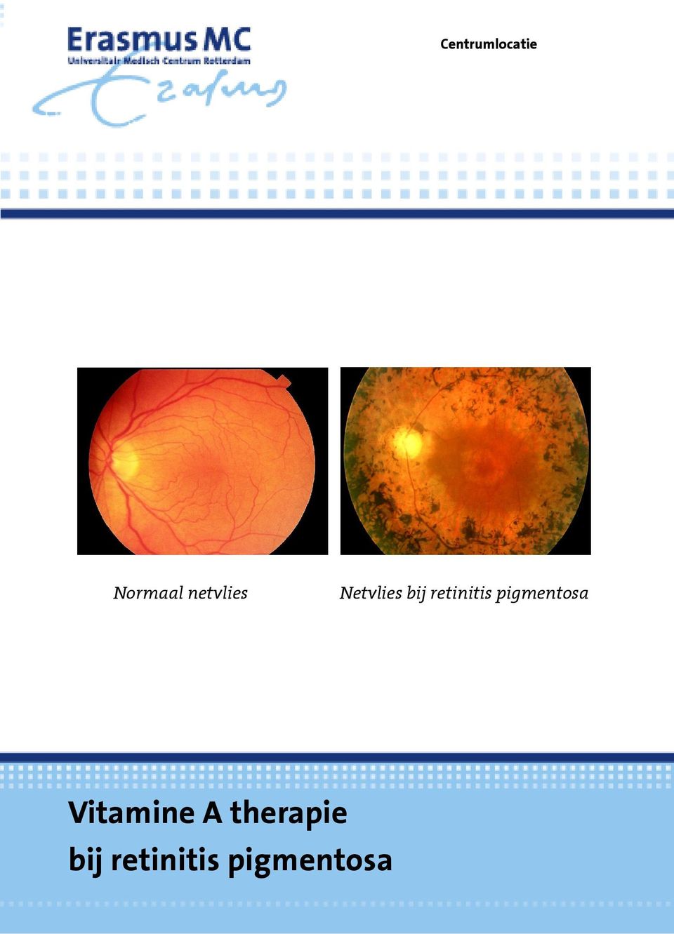 retinitis pigmentosa