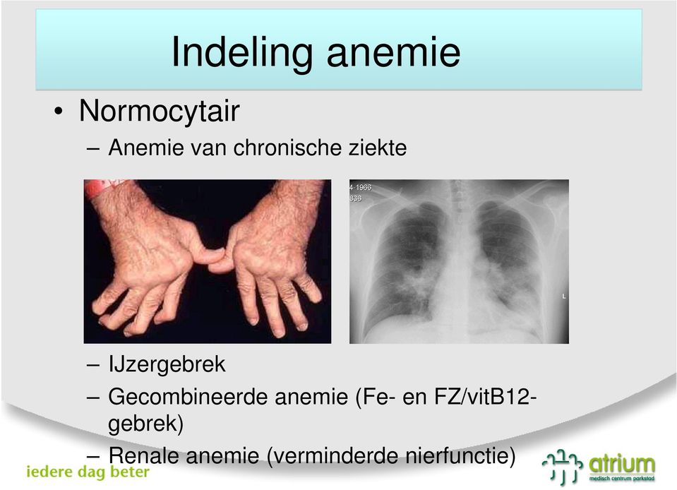 Gecombineerde anemie (Fe- en