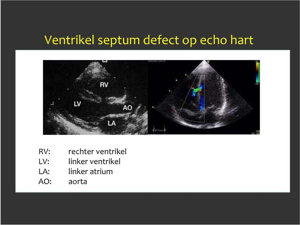 rechter ventrikel linker