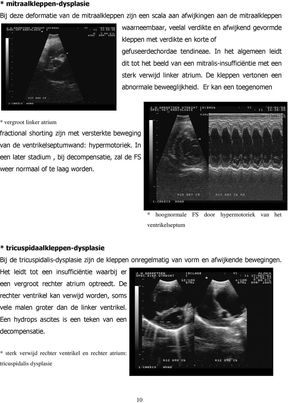 Er kan een toegenomen * vergroot linker atrium fractional shorting zijn met versterkte beweging van de ventrikelseptumwand: hypermotoriek.