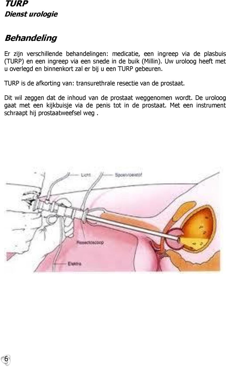 TURP is de afkrting van: transurethrale resectie van de prstaat.