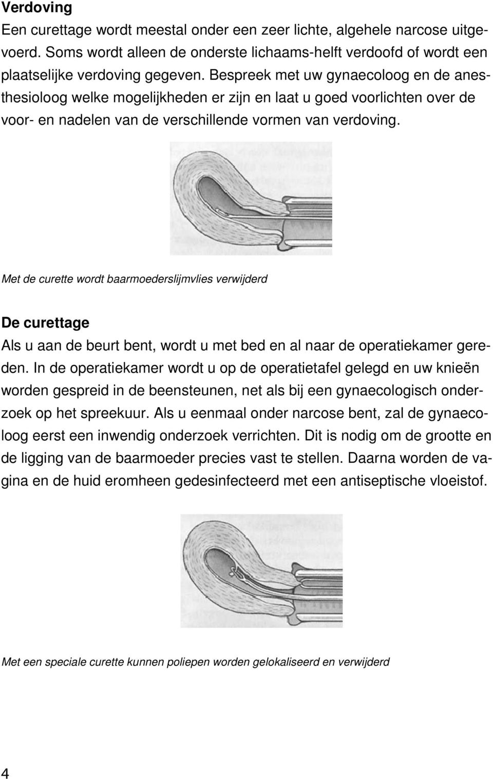 Met de curette wordt baarmoederslijmvlies verwijderd De curettage Als u aan de beurt bent, wordt u met bed en al naar de operatiekamer gereden.