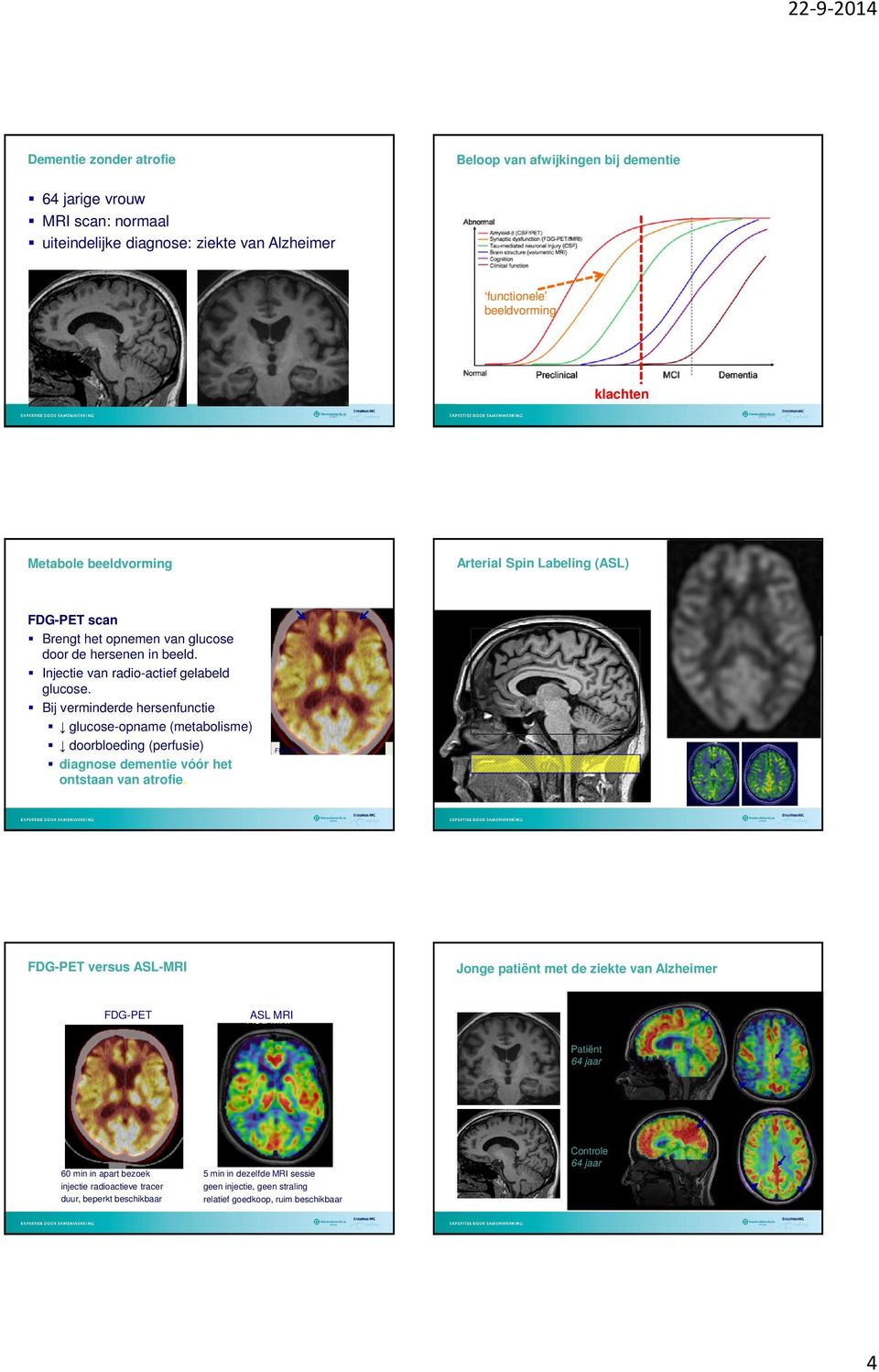 Bij verminderde hersenfunctie glucose-opname (metabolisme) doorbloeding (perfusie) diagnose dementie vóór het ontstaan van atrofie.