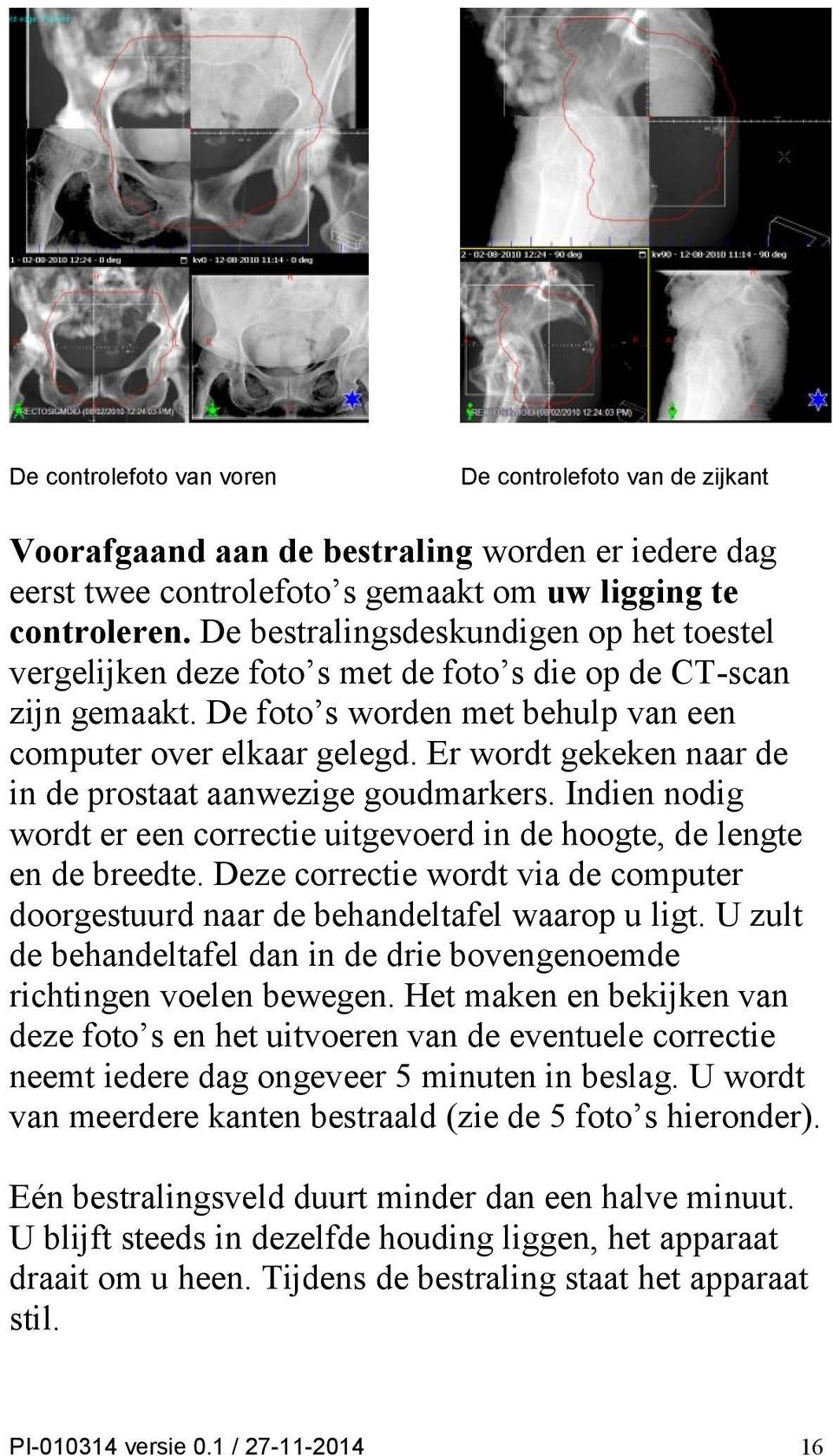 Er wordt gekeken naar de in de prostaat aanwezige goudmarkers. Indien nodig wordt er een correctie uitgevoerd in de hoogte, de lengte en de breedte.