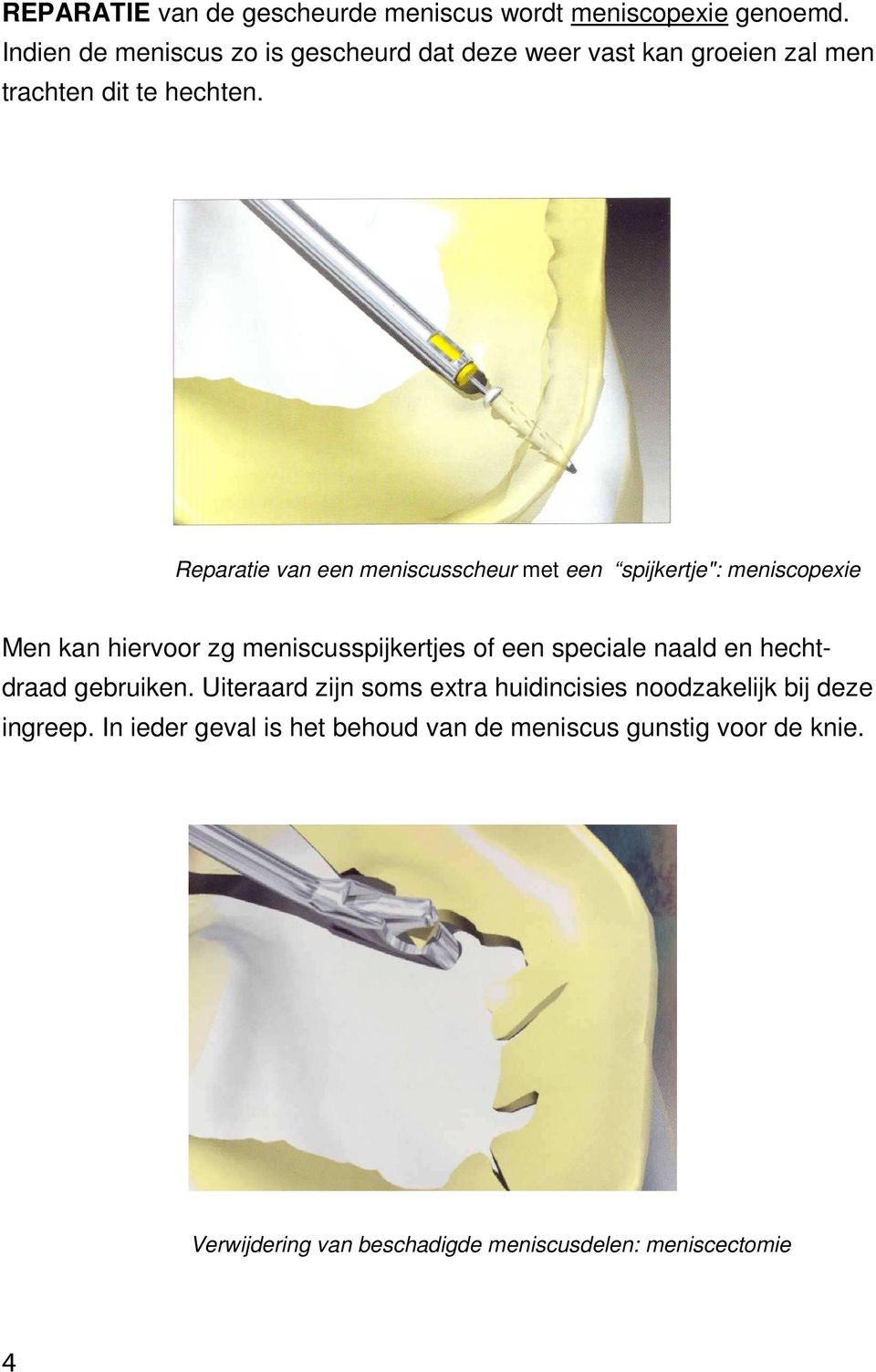 Reparatie van een meniscusscheur met een spijkertje": meniscopexie Men kan hiervoor zg meniscusspijkertjes of een speciale naald