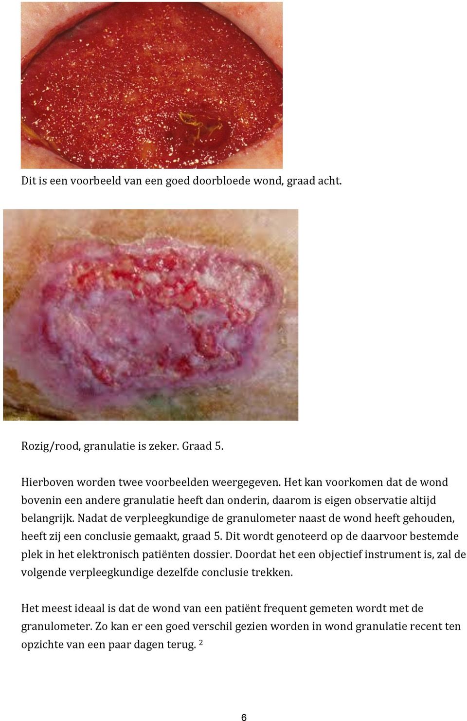Nadat de verpleegkundige de granulometer naast de wond heeft gehouden, heeft zij een conclusie gemaakt, graad 5.