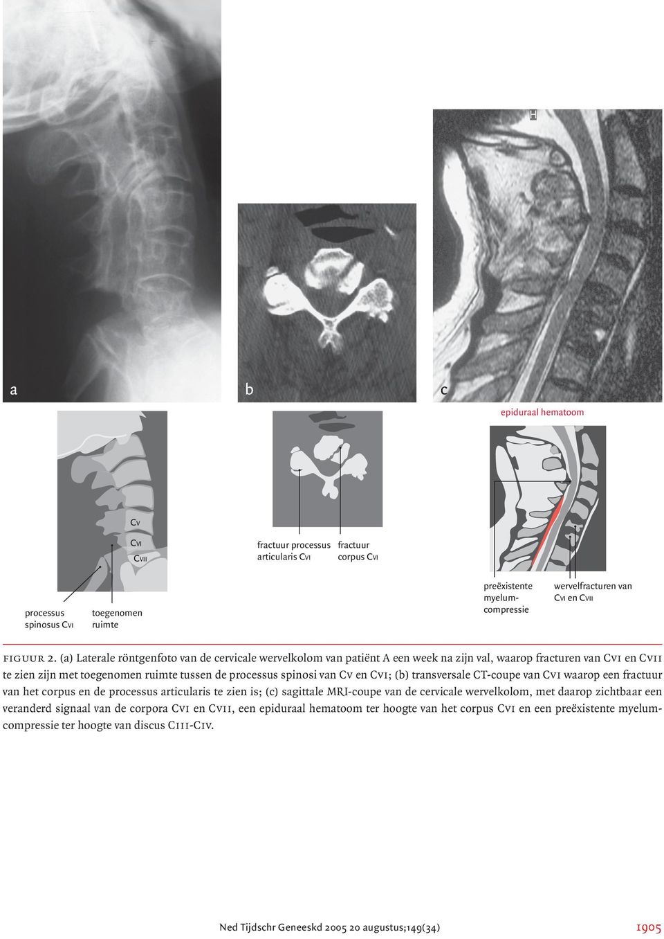 (a) Laterale röntgenfoto van de cervicale wervelkolom van patiënt A een week na zijn val, waarop fracturen van Cvi en Cvii te zien zijn met toegenomen ruimte tussen de processus spinosi van Cv en