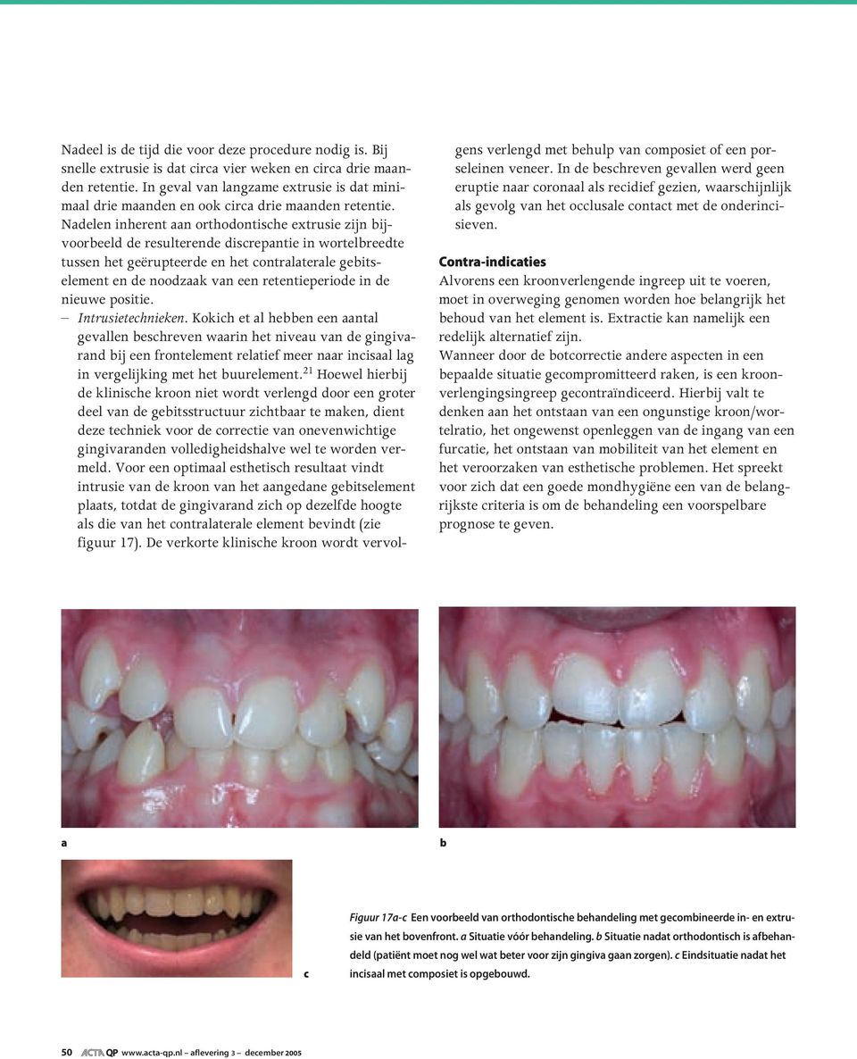 Nadelen inherent aan orthodontische extrusie zijn bijvoorbeeld de resulterende discrepantie in wortelbreedte tussen het geërupteerde en het contralaterale gebitselement en de noodzaak van een