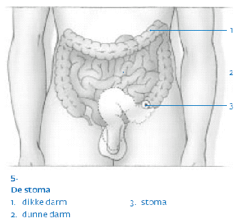 Bij mensen met een tumor in het onderste deel van de endeldarm zal na een curatieve operatie een permanent (blijvend) stoma worden aangelegd. Illustratie 5 geeft u een indruk van een permanent stoma.