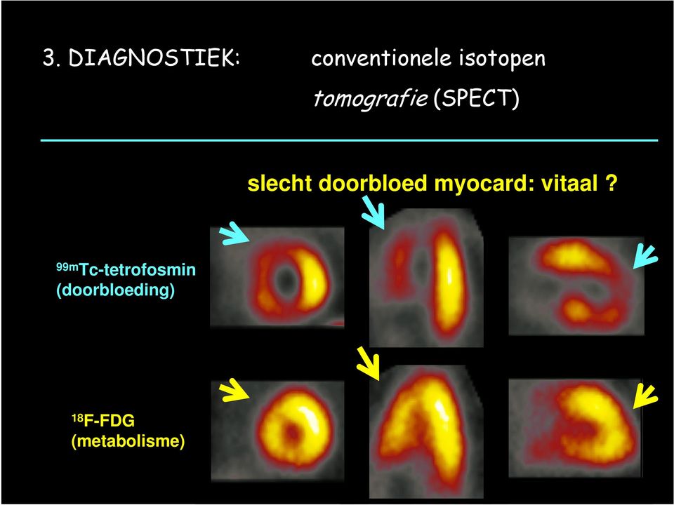 doorbloed myocard: vitaal?