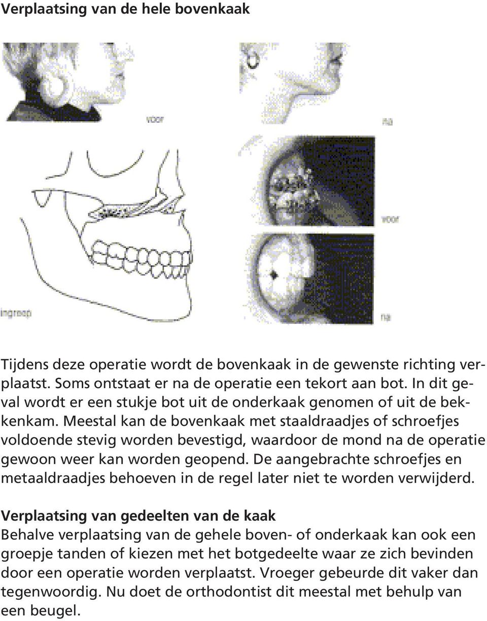 Meestal kan de bovenkaak met staaldraadjes of schroefjes voldoende stevig worden bevestigd, waardoor de mond na de operatie gewoon weer kan worden geopend.