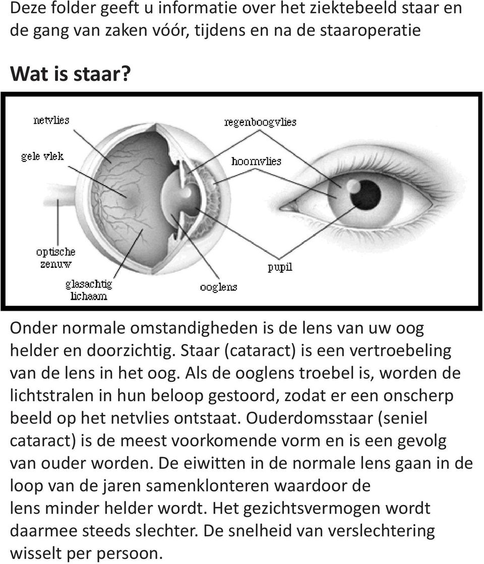 Als de ooglens troebel is, worden de lichtstralen in hun beloop gestoord, zodat er een onscherp beeld op het netvlies ontstaat.