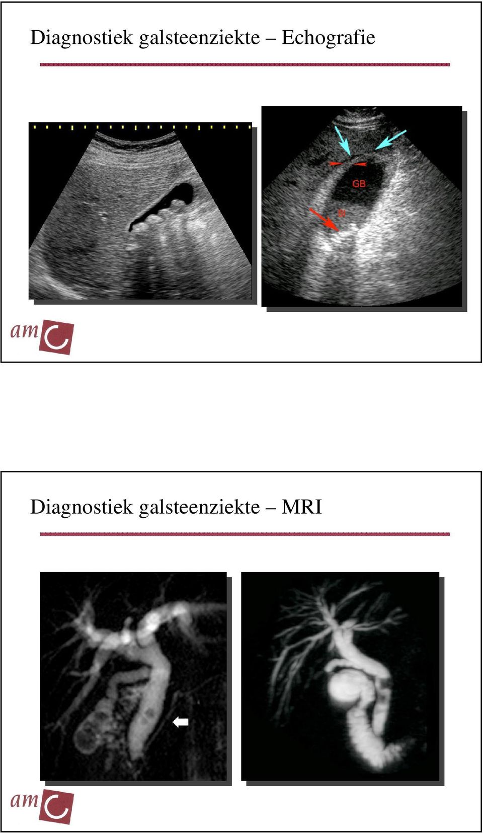 Echografie   MRI