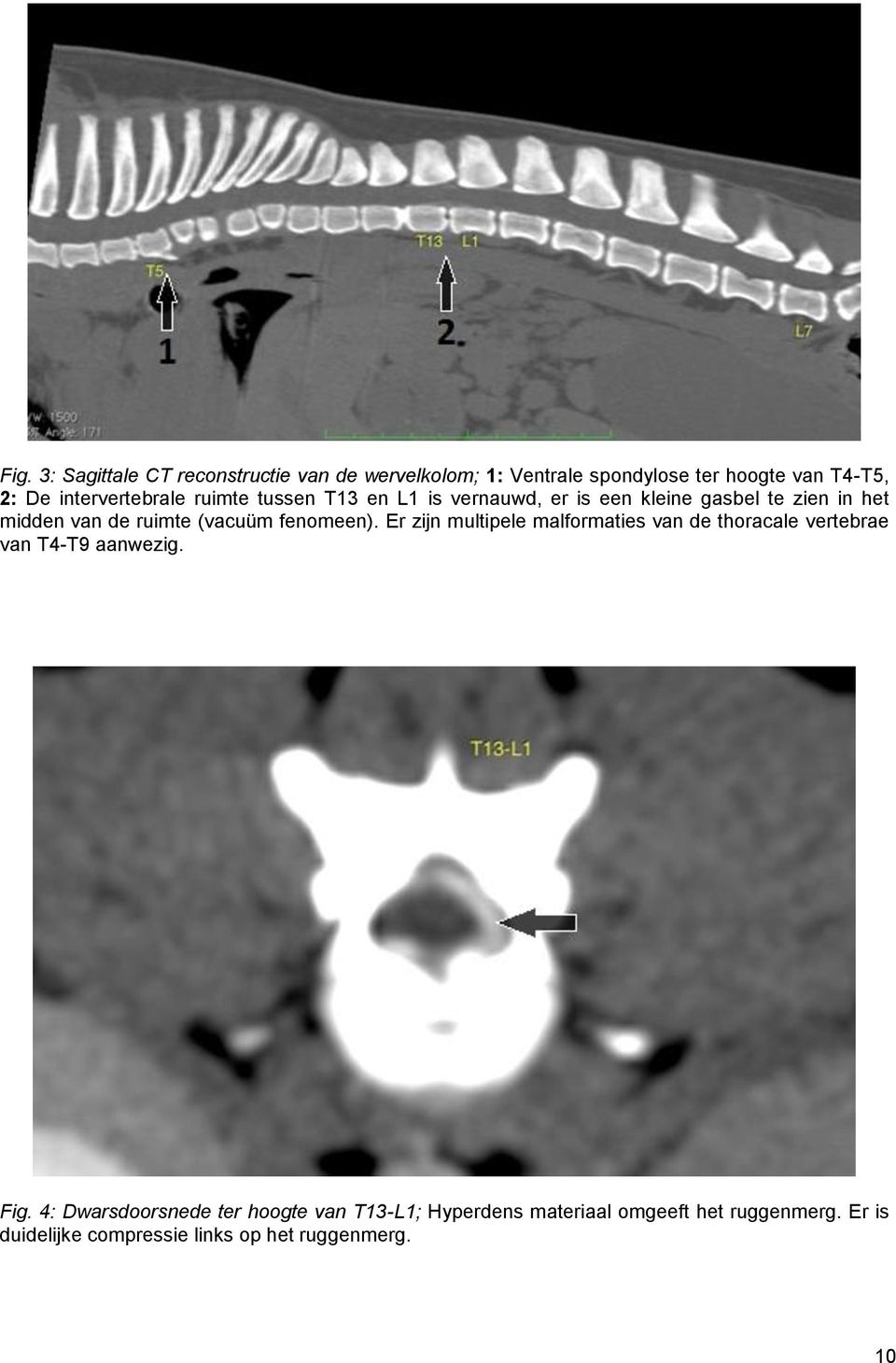 (vacuüm fenomeen). Er zijn multipele malformaties van de thoracale vertebrae van T4-T9 aanwezig. Fig.
