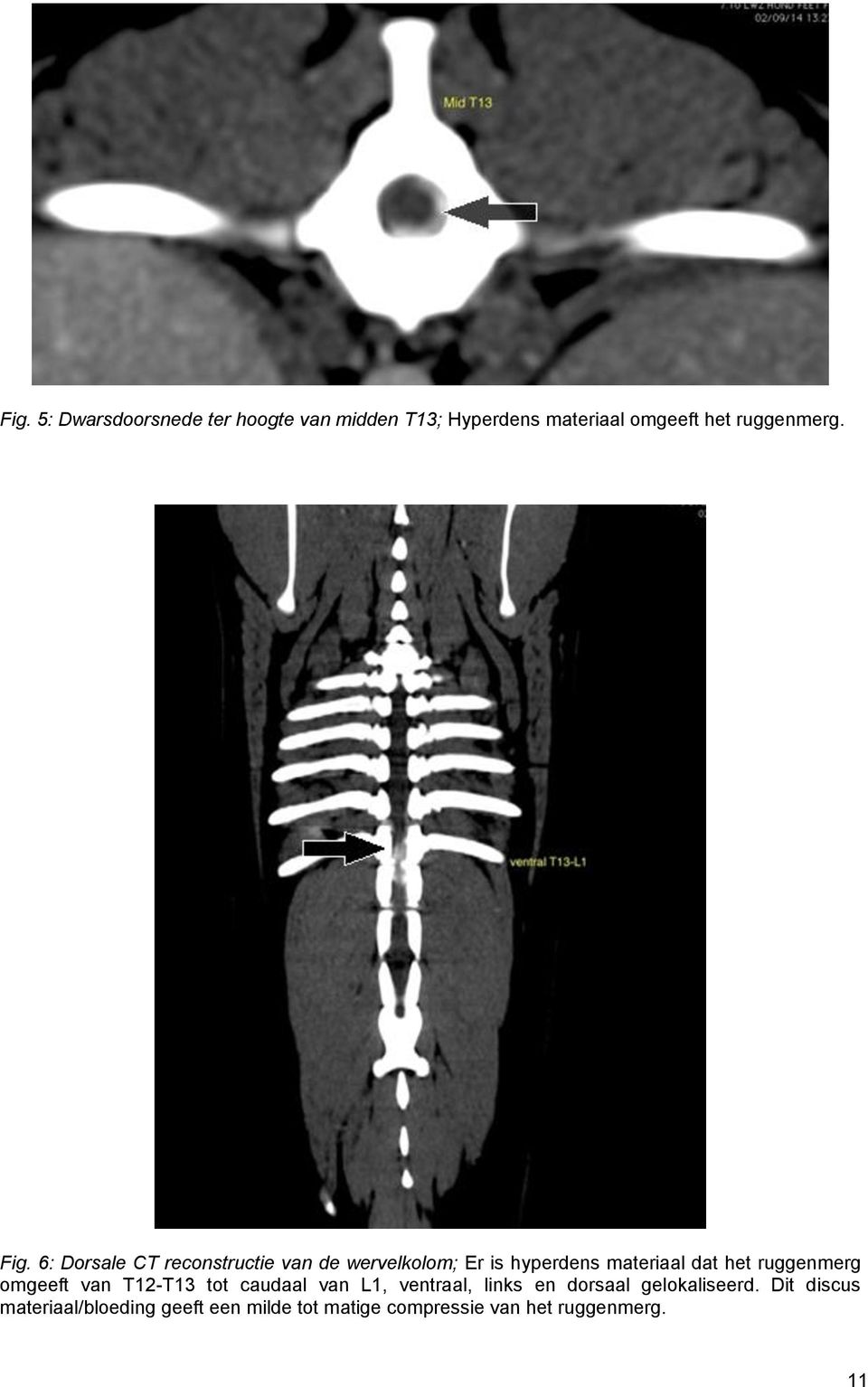 6: Dorsale CT reconstructie van de wervelkolom; Er is hyperdens materiaal dat het