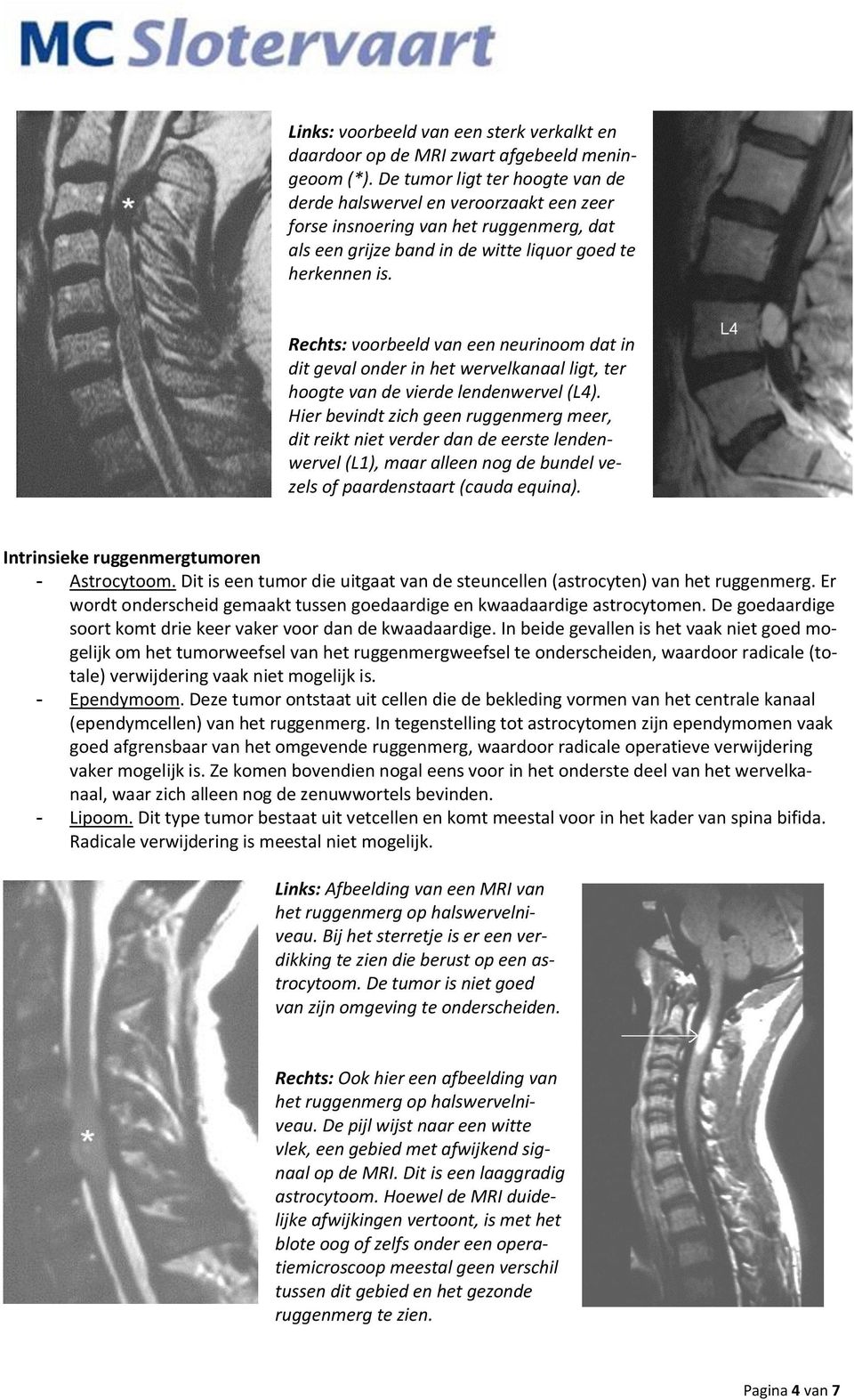 Rechts: voorbeeld van een neurinoom dat in dit geval onder in het wervelkanaal ligt, ter hoogte van de vierde lendenwervel (L4).