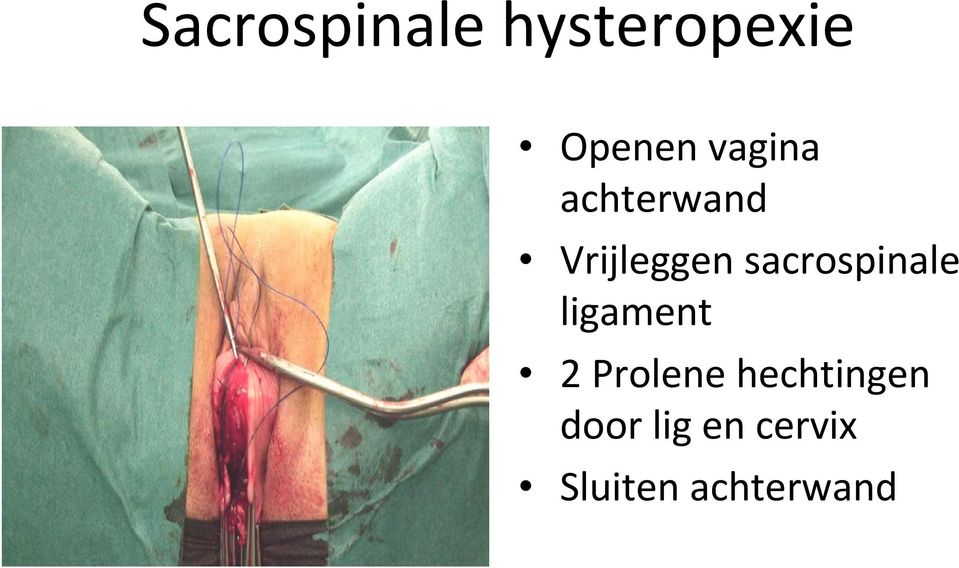 sacrospinale ligament 2 Prolene