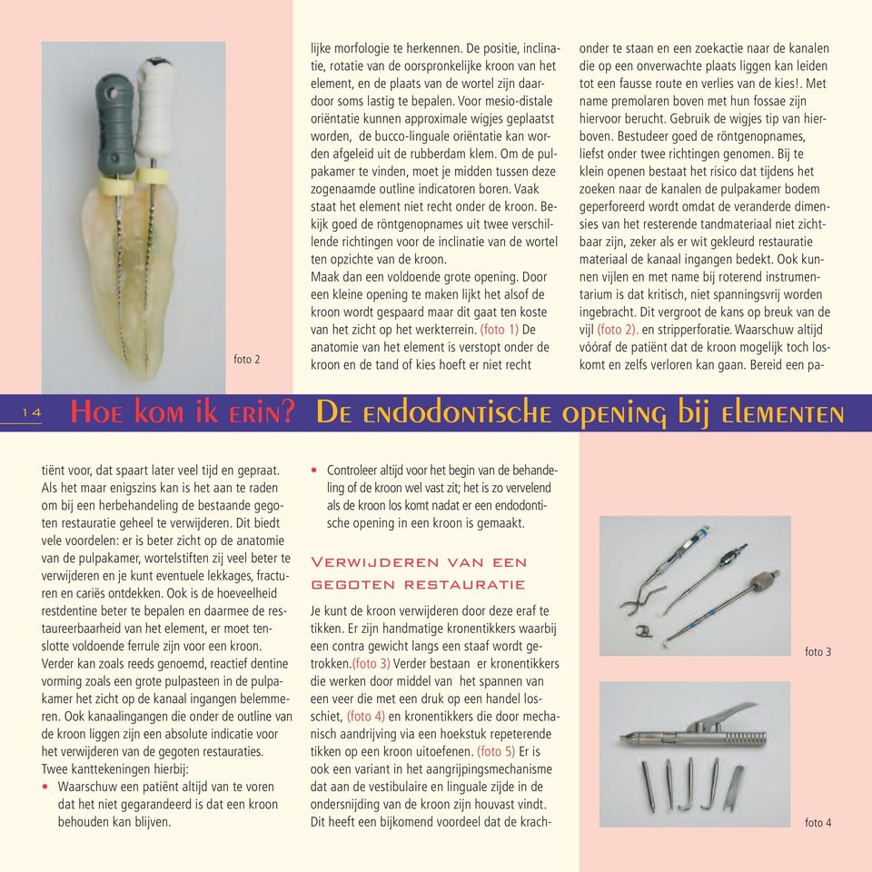 Om de pulpakamer te vinden, moet je midden tussen deze zogenaamde outline indicatoren boren. Vaak staat het element niet recht onder de kroon.