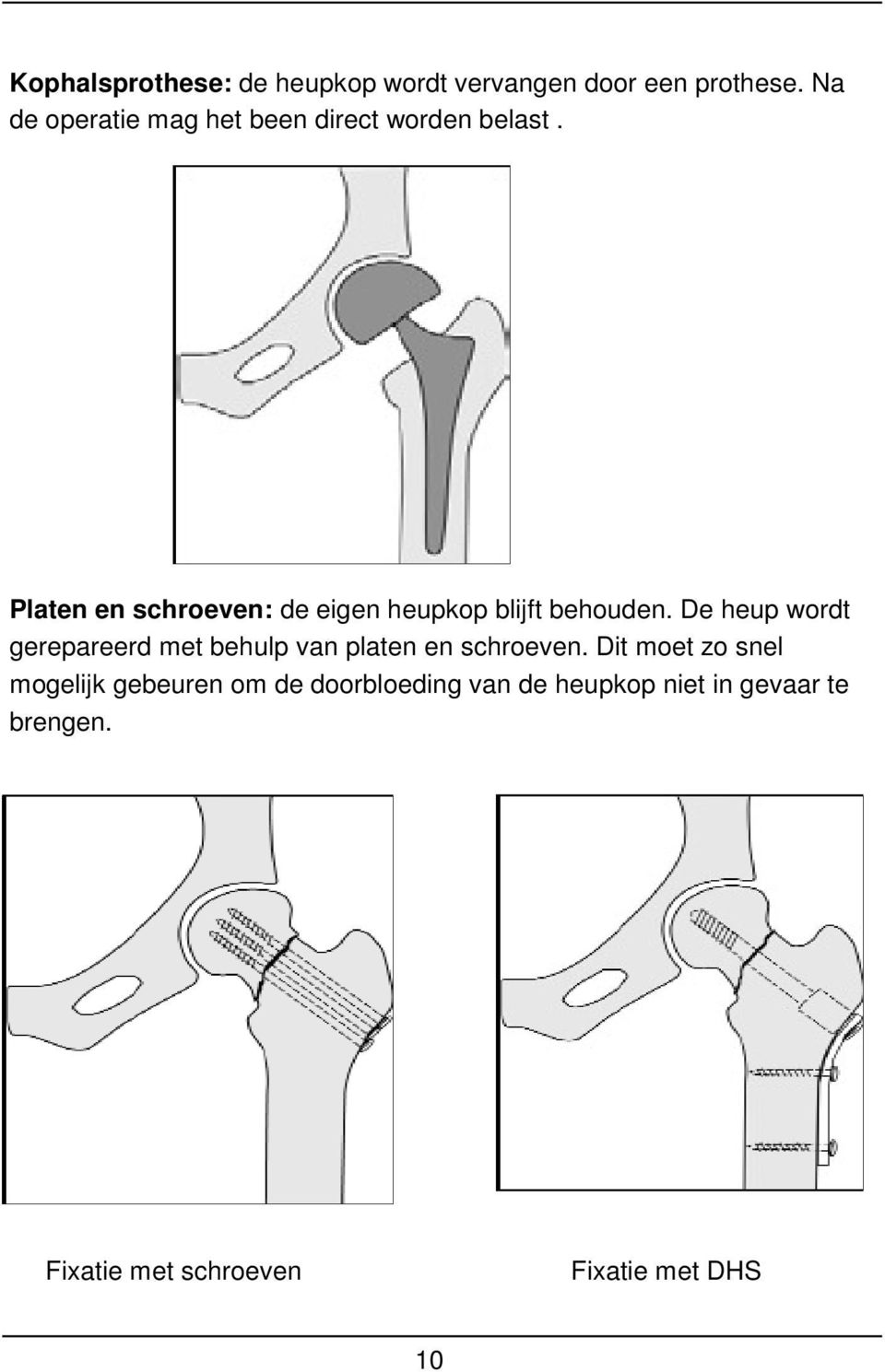 Platen en schroeven: de eigen heupkop blijft behouden.