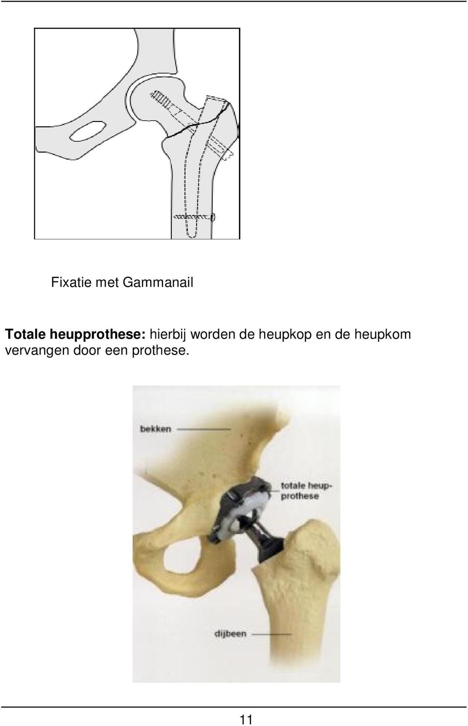 de heupkop en de heupkom