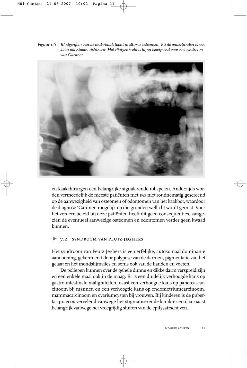 Anderzijds worden vermoedelijk de meeste patiënten met fap niet routinematig gescreend op de aanwezigheid van osteomen of odontomen van het kaakbot, waardoor de diagnose Gardner mogelijk op die