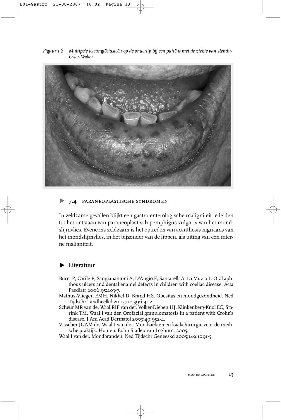 Eveneens zeldzaam is het optreden van acanthosis nigricans van het mondslijmvlies, in het bijzonder van de lippen, als uiting van een interne maligniteit.