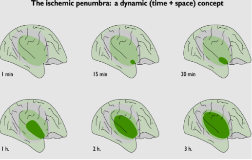 Spoedeisende neurologische zorgstroom: KPI -> CVA Uitwerking traumaregio Zwolle: Time is brain bij een beroerte.