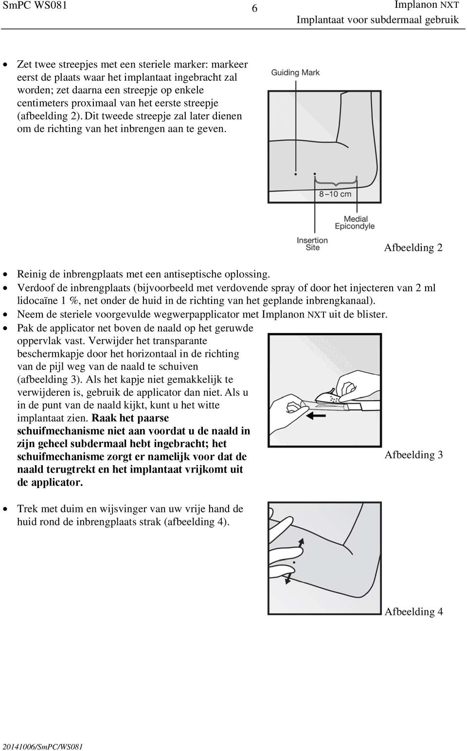 Verdoof de inbrengplaats (bijvoorbeeld met verdovende spray of door het injecteren van 2 ml lidocaïne 1 %, net onder de huid in de richting van het geplande inbrengkanaal).