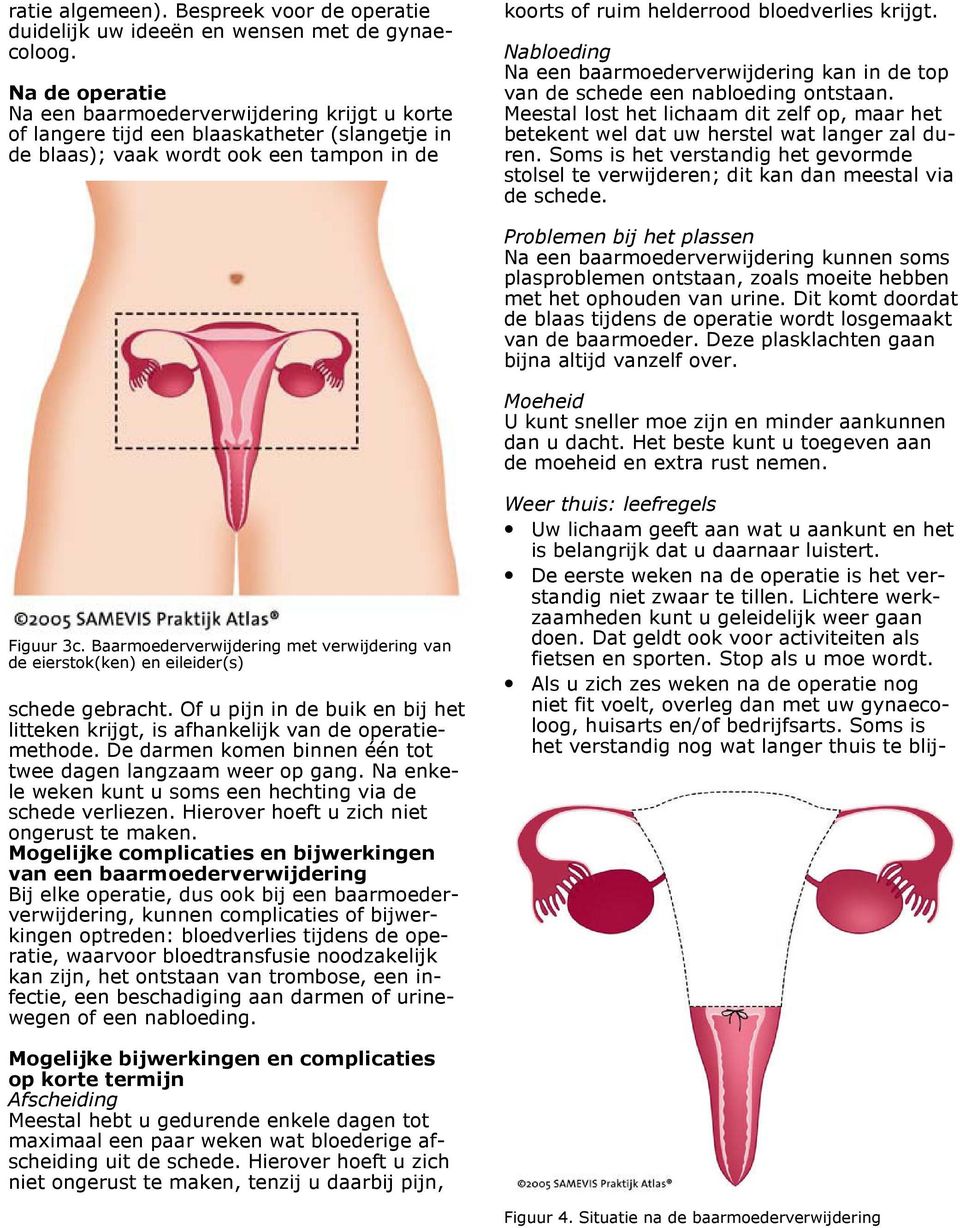 Nabloeding Na een baarmoederverwijdering kan in de top van de schede een nabloeding ontstaan. Meestal lost het lichaam dit zelf op, maar het betekent wel dat uw herstel wat langer zal duren.