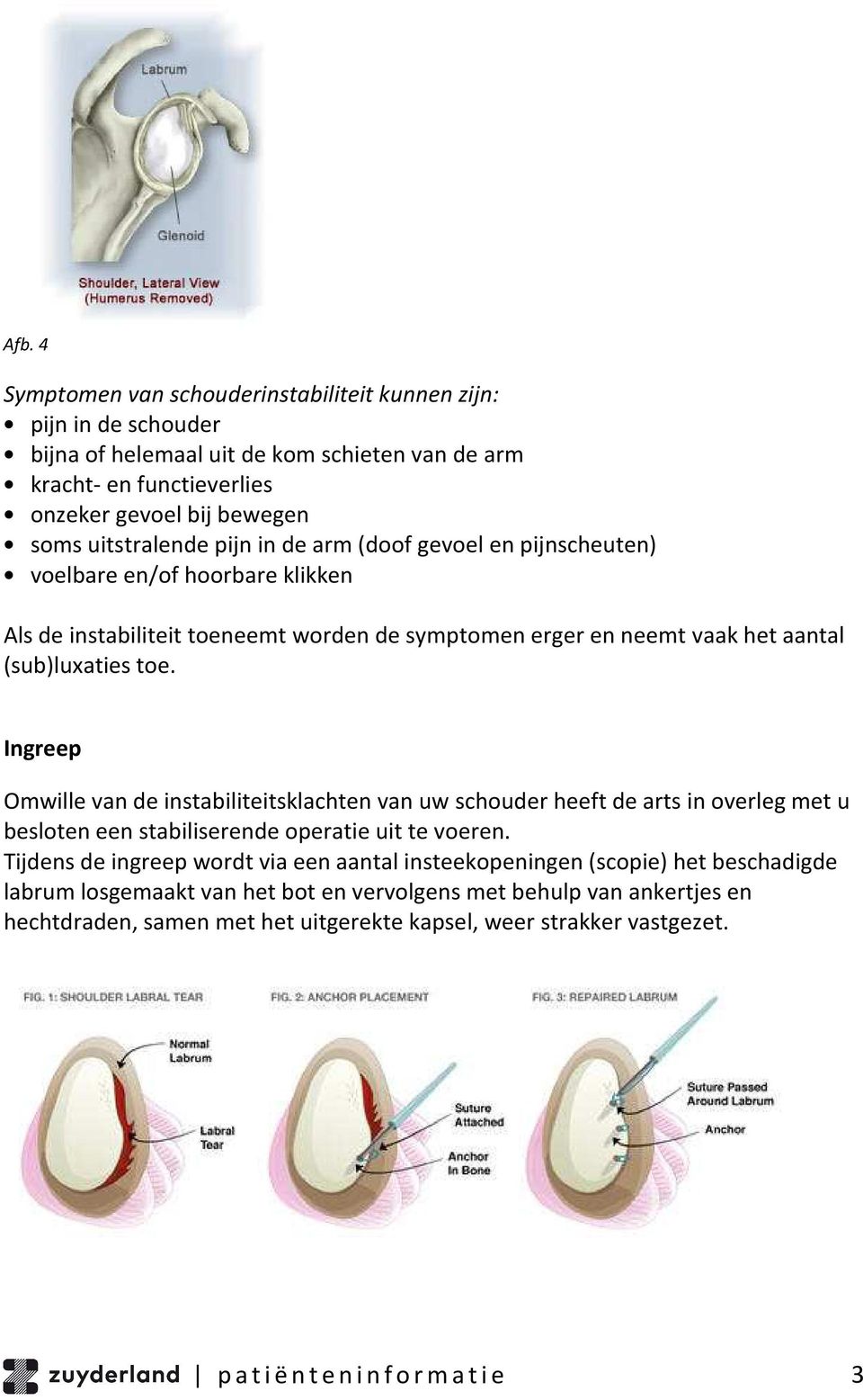 Ingreep Omwille van de instabiliteitsklachten van uw schouder heeft de arts in overleg met u besloten een stabiliserende operatie uit te voeren.