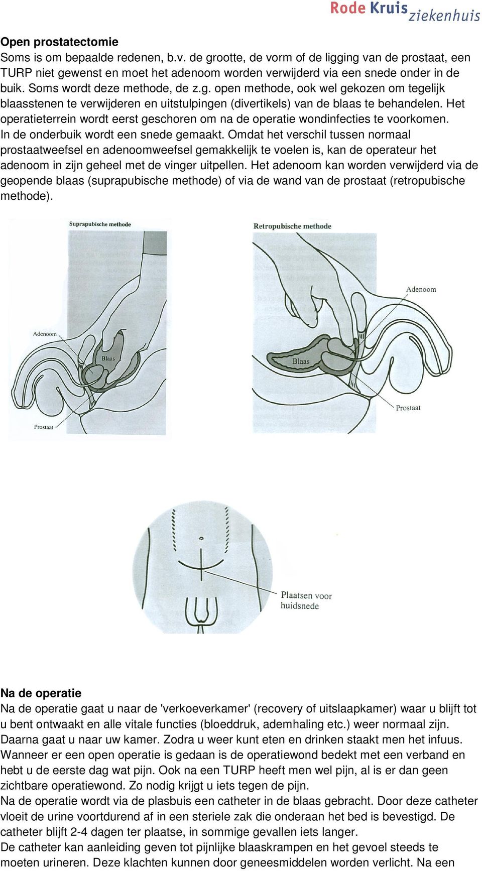 Het operatieterrein wordt eerst geschoren om na de operatie wondinfecties te voorkomen. In de onderbuik wordt een snede gemaakt.