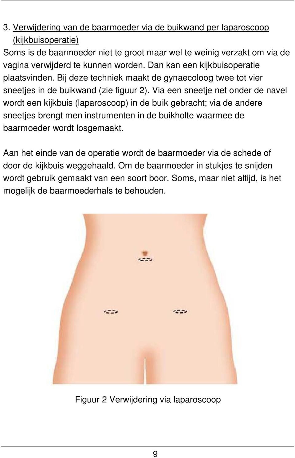 Via een sneetje net onder de navel wordt een kijkbuis (laparoscoop) in de buik gebracht; via de andere sneetjes brengt men instrumenten in de buikholte waarmee de baarmoeder wordt losgemaakt.